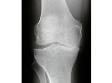Diagnosi di artrosi dell'articolazione del ginocchio