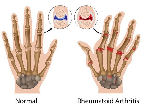 Articolazioni di dita senza patologia e con artrite reumatoide