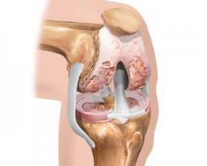 la fase iniziale dell'artrosi del ginocchio