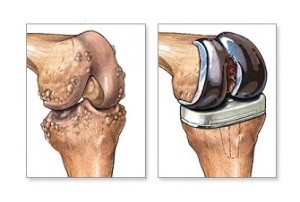 sostituzione del ginocchio per l'artrosi