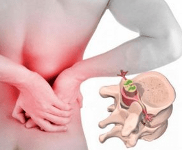 Lumbago all'inizio della malattia osteocondosi