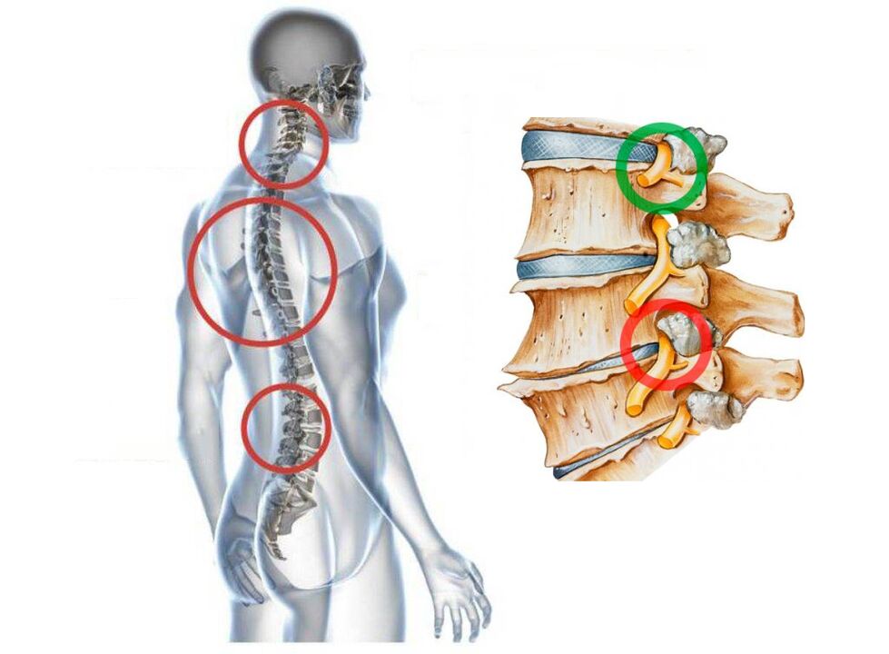 Come appare l'osteocondosi cervicale delle vertebre