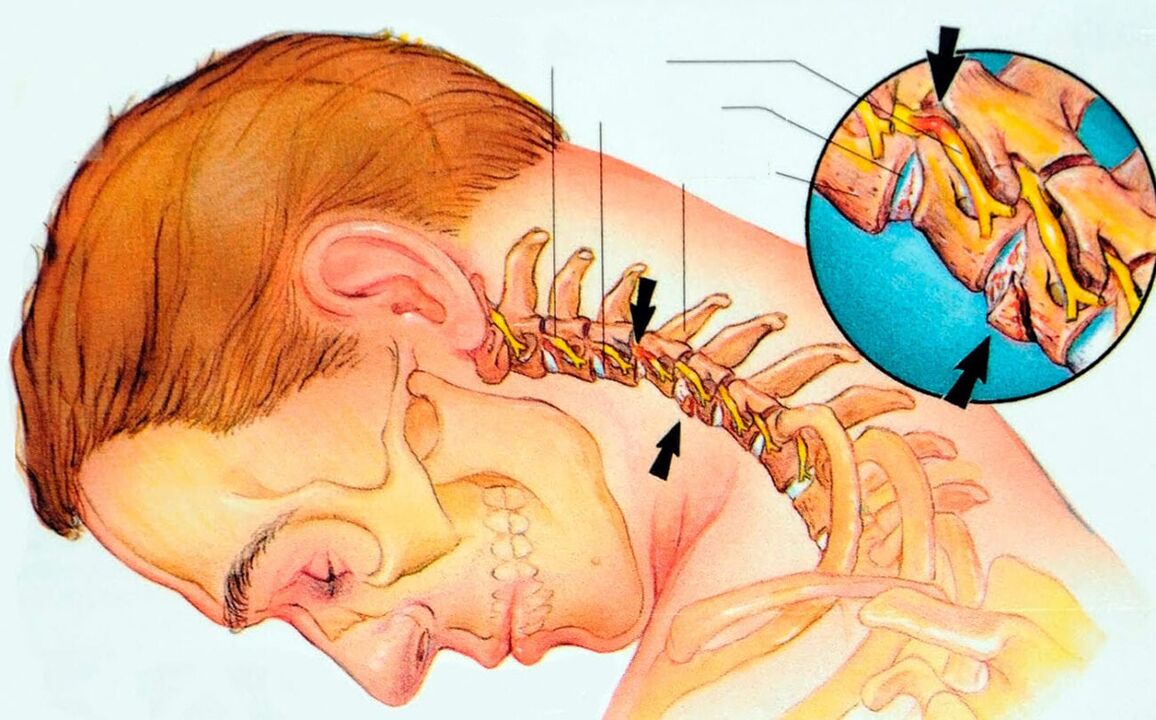 Cos'è l'osteocondosi cervicale