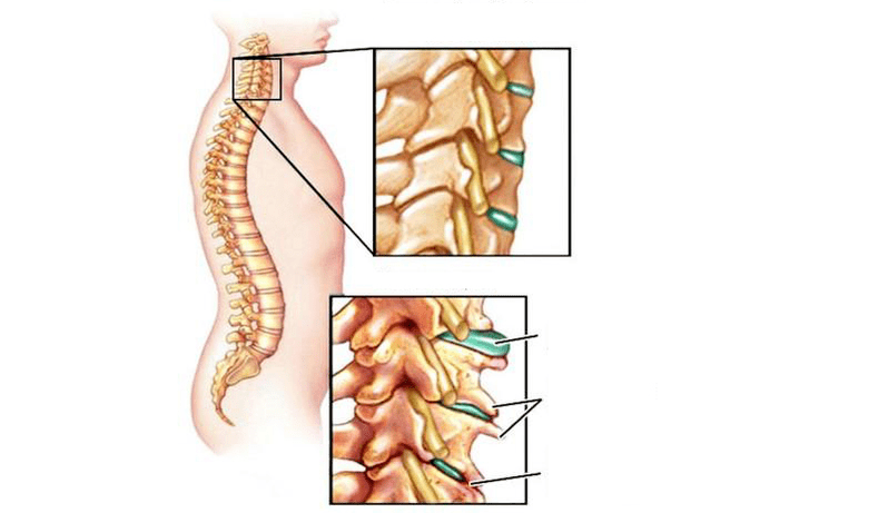 Sindromi di osteocondrosi