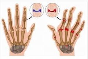 differenze tra artrite e artrosi delle mani