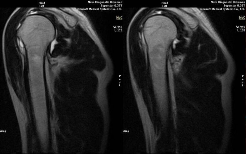 artrosi dell'articolazione della spalla alla radiografia