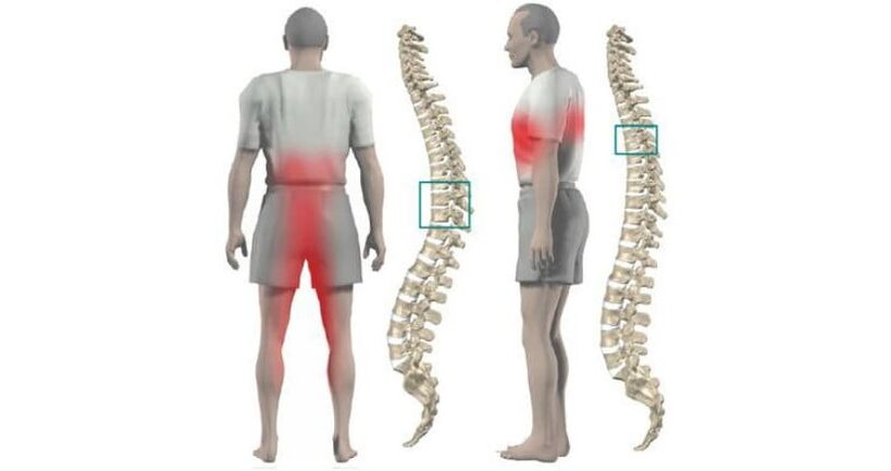 dolore al corpo e alla colonna vertebrale con osteocondrosi