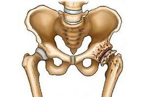 distruzione dell'articolazione dell'anca nell'artrosi