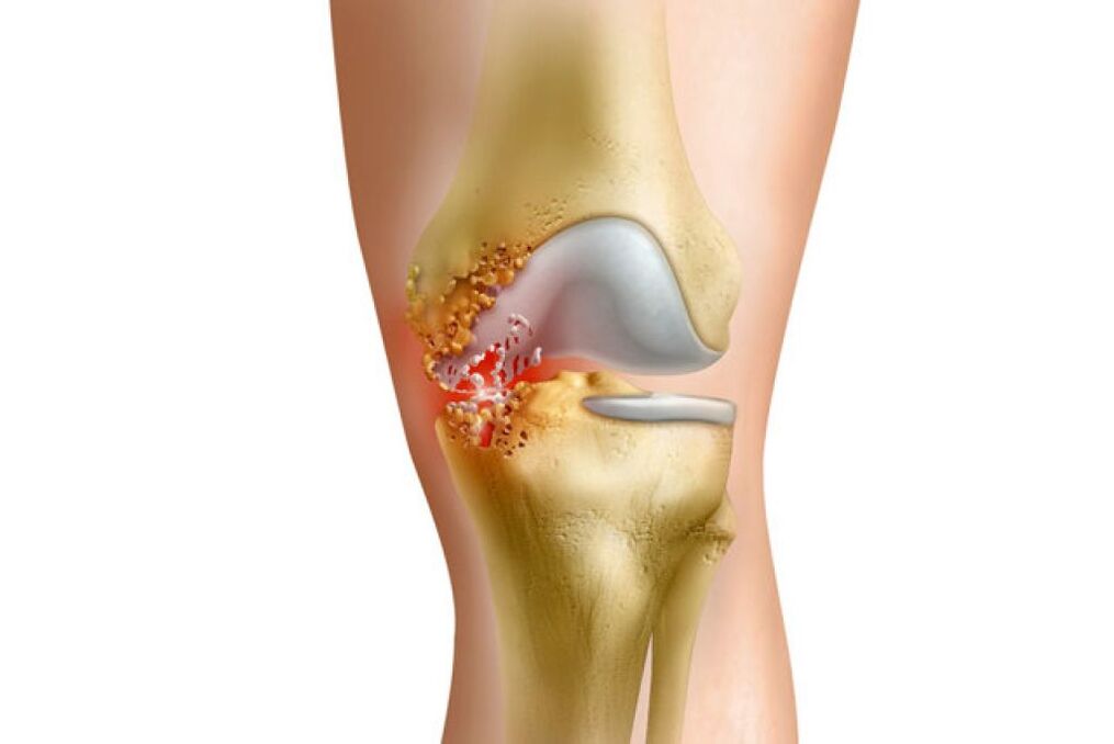 infiammazione come causa di dolore nell'articolazione dell'anca