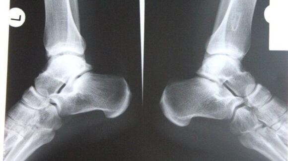 Diagnosi dell'artrosi della caviglia mediante radiografia