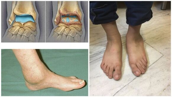 Gonfiore e deformazione dell'articolazione della caviglia dovuti all'artrosi