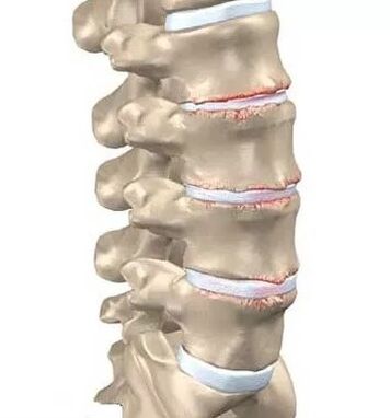 Osteocondrosi